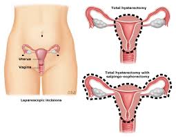 patient education inal hysterectomy