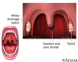 tonsillitis information mount sinai