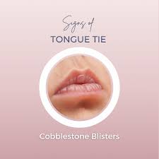 signs of tongue tie lactation