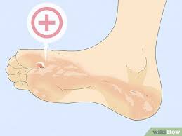 6 ways to get rid of foot fungus wikihow