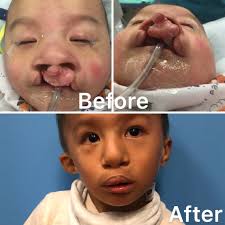 pediatric cleft lip surgery new york