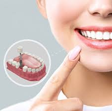 dental implants cost in coimbatore