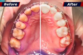 how to remove plaque and tartar from