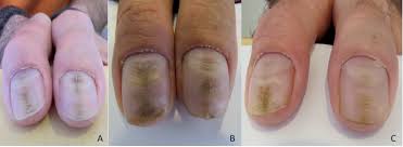can an nail dystrophy be an adverse