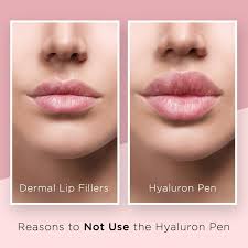 what you should know about the hyaluron pen