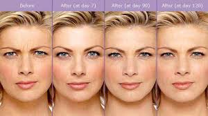 botox and fillers ① nyc