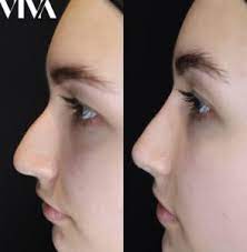 nose filler treatment