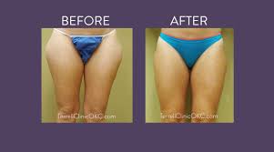 inner and outer thigh liposuction