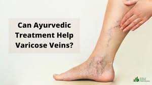 can ayurvedic treatment help varicose veins