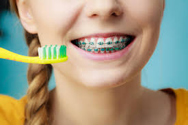 If you weren't getting cavities before and now you are, it's highly likely that something in your. Brushing With Braces How To Keep Your Braces Clean Jiva Dental