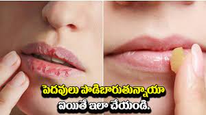 remes to heal dry lips naturally