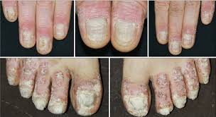 severe 20 nail and nail fold psoriasis