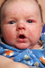 baby eczema how to prevent it and safe