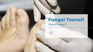 fungal toenail treatment moore foot