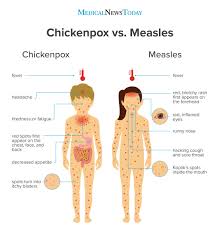 Chickenpox Vs Measles Symptoms Pictures Treatment And More