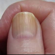 what do nail problems mean for your health