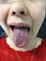 muscle weakness of mouth region fazialis