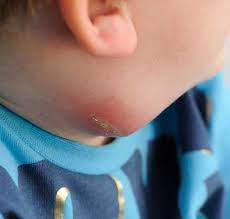 abscesses boils in children s