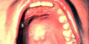 mouth cancer pictures what