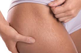 stretch mark removal treatment in
