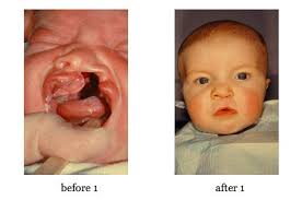 cleft lip repair and cleft palate