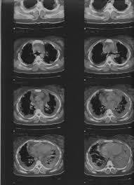 The pleura are thin membranes that line the lungs and the. Bilateral Loculated Pleural Effusion As A Manifestation Of Acute Parenteral Organophosphate Intoxication A Case Report Journal Of Emergency Medicine