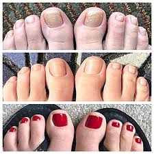 fungal nail eraser toenail treatment
