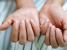curved nails causes of spoon nails and