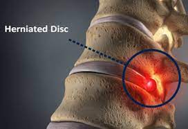 herniated disc causes symptoms