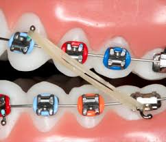 Rubber bands with braces may seem difficult, but with a few tips and tricks from this article, you'll know how to put rubber bands on braces in no time. Why Do I Have To Wear Rubberbands