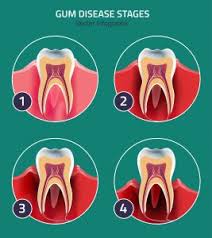 the ultimate guide to gum disease