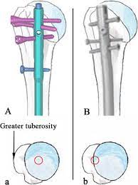 proximal humerus fractures