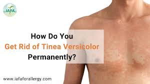 get rid of tinea versicolor permanently
