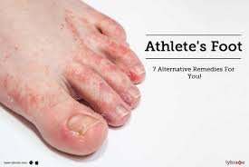 athlete s foot 7 alternative remes