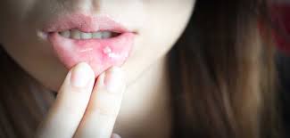 mouth ulcers causes treatments