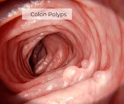 colonoscopy and polyp removal coding