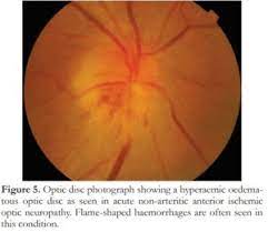 Since the early 1980s, steroids have been used in an attempt to reduce the abnormal swelling that follows an injury to the optic nerve and improve visual recovery. Ischaemic Optic Neuropathy In Southeast Asia A Different Pattern Of Disease Philippine Journal Of Ophthalmology