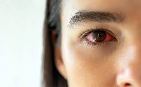 how to relieve a red eye healthxchange sg