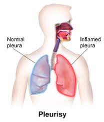 Chest wall pain is one of the more common causes of chest pain with deep breathing and coughing. Pleurisy Wikipedia