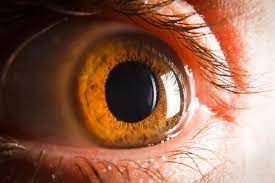 Seventeen consecutive eyes with corneal epithelial basement membrane with symptoms of recurrent erosion and/or decreased vision were treated with corneal epithelial basement membranectomy. Epithelial Basement Membrane Dystrophy Ebmd Overview