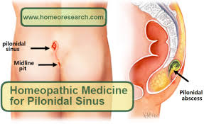 pilonidal sinus treatment in homeopathy