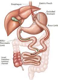 anatomy of gastric byp patients