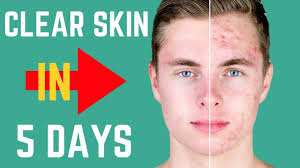 how to really get clear skin in 5 days