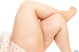 how can liposuction treat lipedema