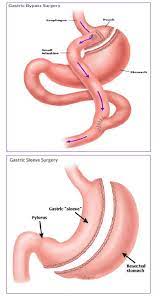 tary guidance after gastric byp