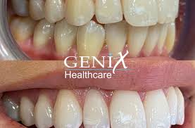 teeth whitening genix healthcare