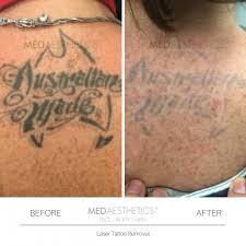 Not happy with the quality (some lines are thick and some thin) and the heart is not shaped right. Laser Tattoo Removal Perth