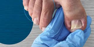 podiatrists help with ingrown toenails