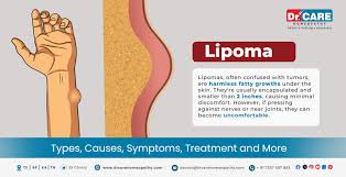 lipoma types causes symptoms