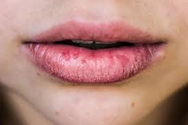 how to avoid chapped lips this winter